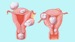 子宮肌瘤