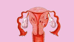 子宮內(nèi)膜肌腺癥